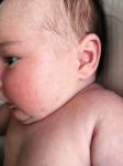 Акне новорожденных или аллергия фото 2