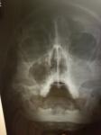 Мог ли врач ошибочно поставить диагноз: полип носа? фото 2