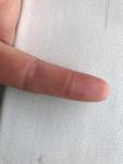 Образование на сгибе пальца под кожей, болит при нажатии фото 2