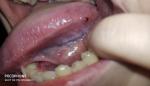 Кровяной шарик на языке, воспаление зуба мудрости фото 1