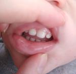 Налет и ямки в зубе фото 1