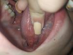 Язвочки на щеках и воспалённый язык фото 2