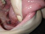 Язвочки на щеках и воспалённый язык фото 3