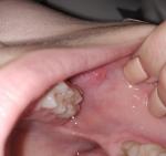 Язвочки на щеках и воспалённый язык фото 1
