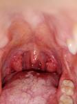 Хронические заболевания горла фото 3