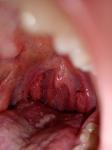 Хронические заболевания горла фото 2