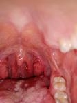Хронические заболевания горла фото 1