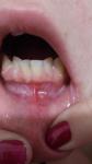 Стоматит, инфекция с язвами во рту фото 1