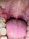 Воспаление десны после зуба мудрости фото 1