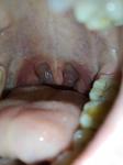 Увеличена миндалина, красное горло фото 1