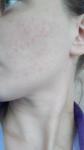 Сыпь на лице с покраснением и разжиганием фото 2