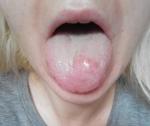Опух язык и болит фото 1