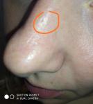 Впадина на коже носа и болезненные ощущения фото 5