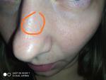 Впадина на коже носа и болезненные ощущения фото 4