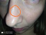 Впадина на коже носа и болезненные ощущения фото 3