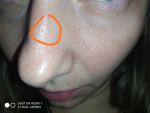 Впадина на коже носа и болезненные ощущения фото 2