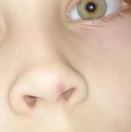 На носу у ребенка маленький синячок фото 1