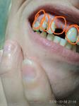 Зубы, натертости от протеза фото 1