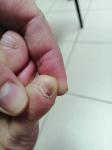Коричневое пятно на ногте мизинца ноги фото 1