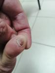 Коричневое пятно на ногте мизинца ноги фото 2