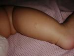 Мелкие прыщики, шершавое пятно у ребёнка 6 месяцев фото 5