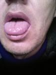 Восполения языка и десны при ПВТ от гипатита с фото 1