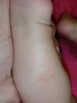 Мелкие прыщики, шершавое пятно у ребёнка 6 месяцев фото 1
