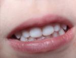 Кариес на передних молочных зубах фото 1
