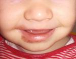 Покраснение под губой у ребенка фото 1