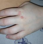 Сыпь на руке у ребенка фото 2