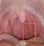 Странное образование на стенке глотки фото 3