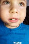 Сыпь вокруг рта не проходит более месяца у ребёнка 2 года фото 1