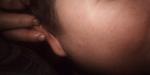 Образование на мочке уха, похожее на надутую кожу фото 1