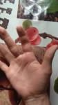Опух пальца и руки- укус фото 1