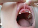 Шишка после выпадения молочного зуба фото 1
