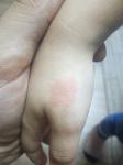 Красное пятно на руке у ребенка 4 года фото 1