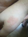 Красное пятно на руке у ребенка 4 года фото 3