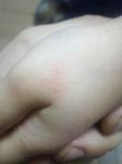 Красное пятно на руке у ребенка 4 года фото 4