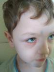 Аллергический коньюктивит, атопический дерматит (ребенок) фото 1