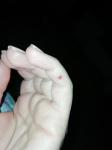 Кровяной пузырь на пальце руки фото 1