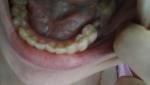 Удаление зуба, состояние после фото 1
