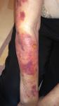 Воспаление кожи рук (дерматит на фоне метипреда) фото 5