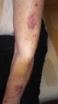 Воспаление кожи рук (дерматит на фоне метипреда) фото 4