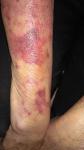 Воспаление кожи рук (дерматит на фоне метипреда) фото 3