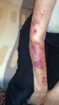 Воспаление кожи рук (дерматит на фоне метипреда) фото 1