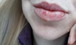 Незаживающая рана на губе после герпеса фото 1