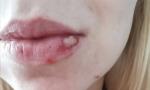 Незаживающая рана на губе после герпеса фото 6