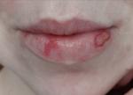 Незаживающая рана на губе после герпеса фото 5