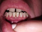 Десна отходят от зубов фото 1