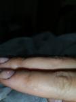 Аллергия на пальцах из за покрытия гель лака фото 3